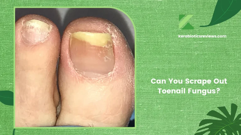 Can You Scrape Out Toenail Fungus? Here Is The Truth!