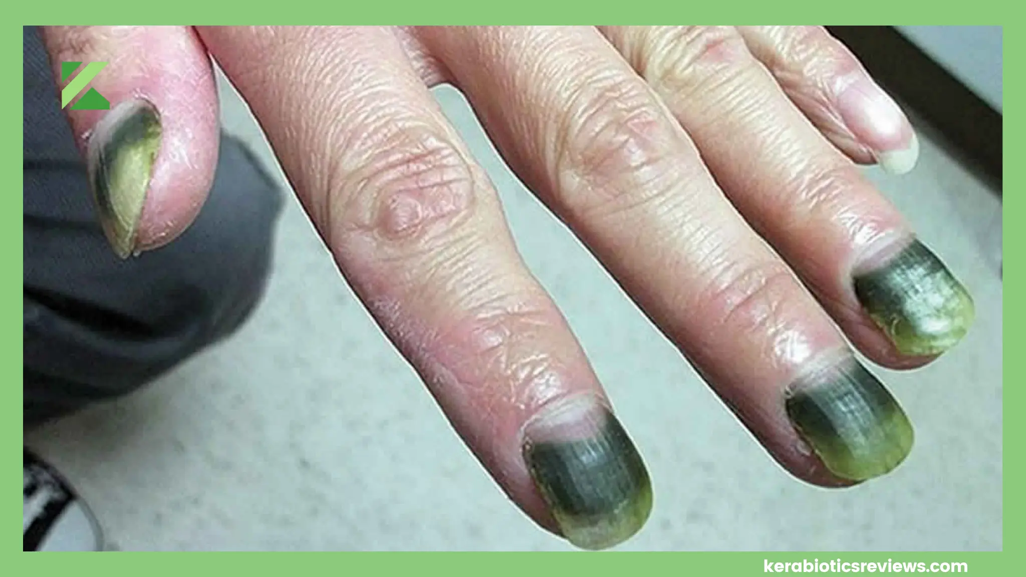 Get Rid Of Green Nail Fungus