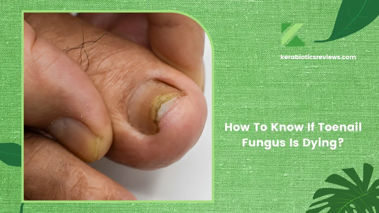 How To Know If Toenail Fungus Is Dying: Signs Of Progress To Look For