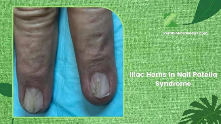 Iliac Horns In Nail Patella Syndrome: All You Need To Know