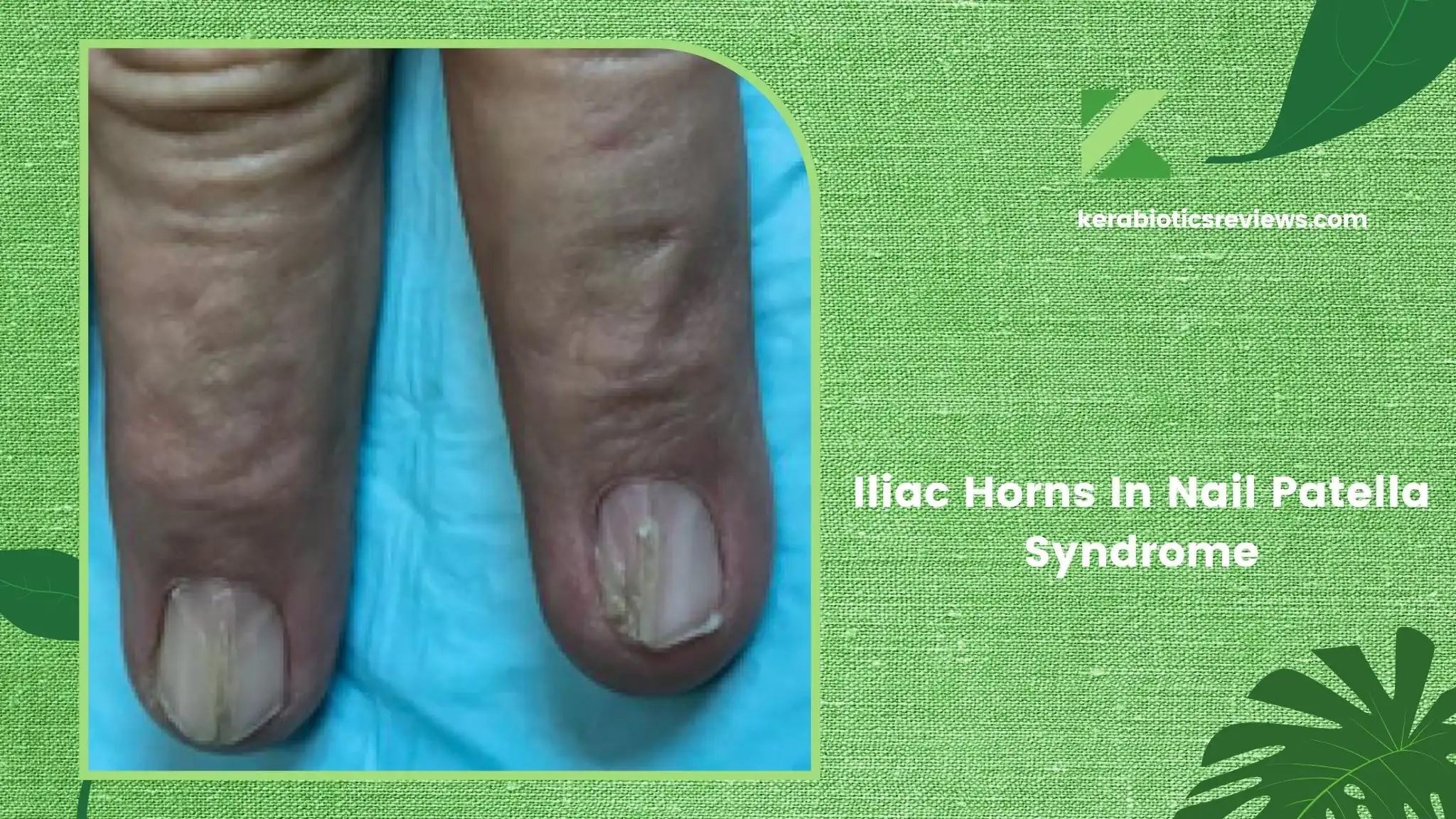 Iliac Horns In Nail Patella Syndrome