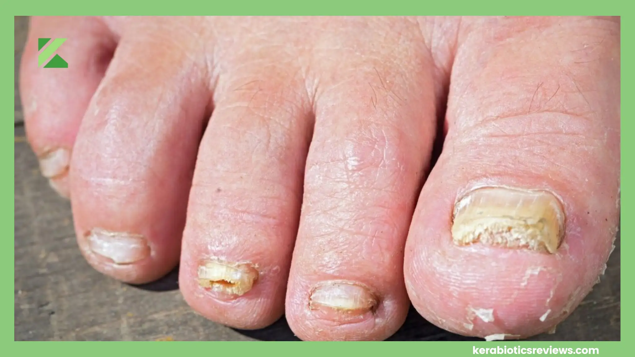 Is Scraping Toenail Fungus Safe