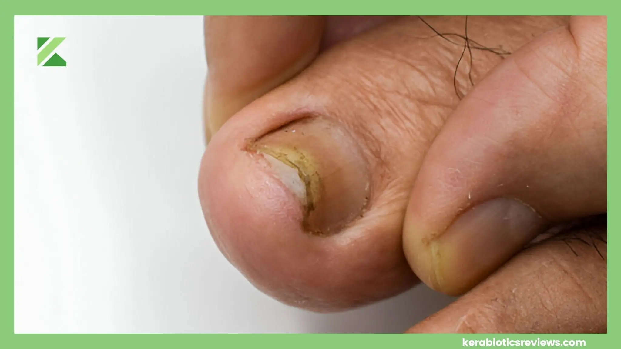 Is Toenail Fungus Contagious