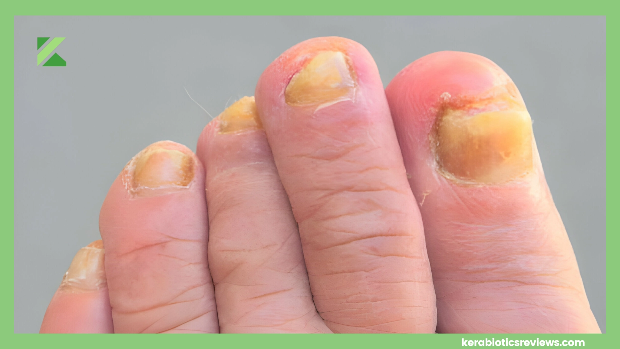 Main Nail Fungus Symptoms