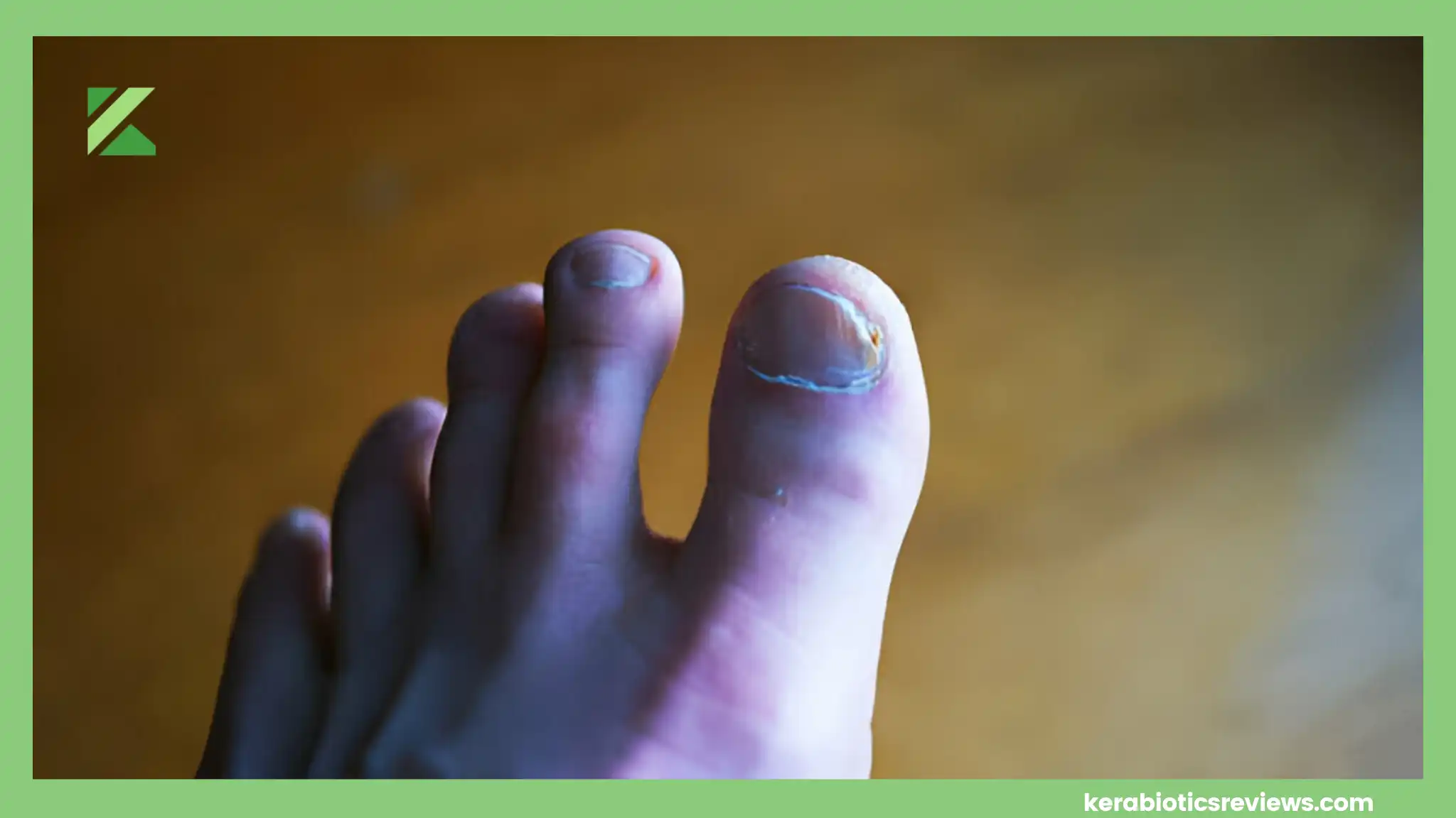 Nail Patella Syndrome