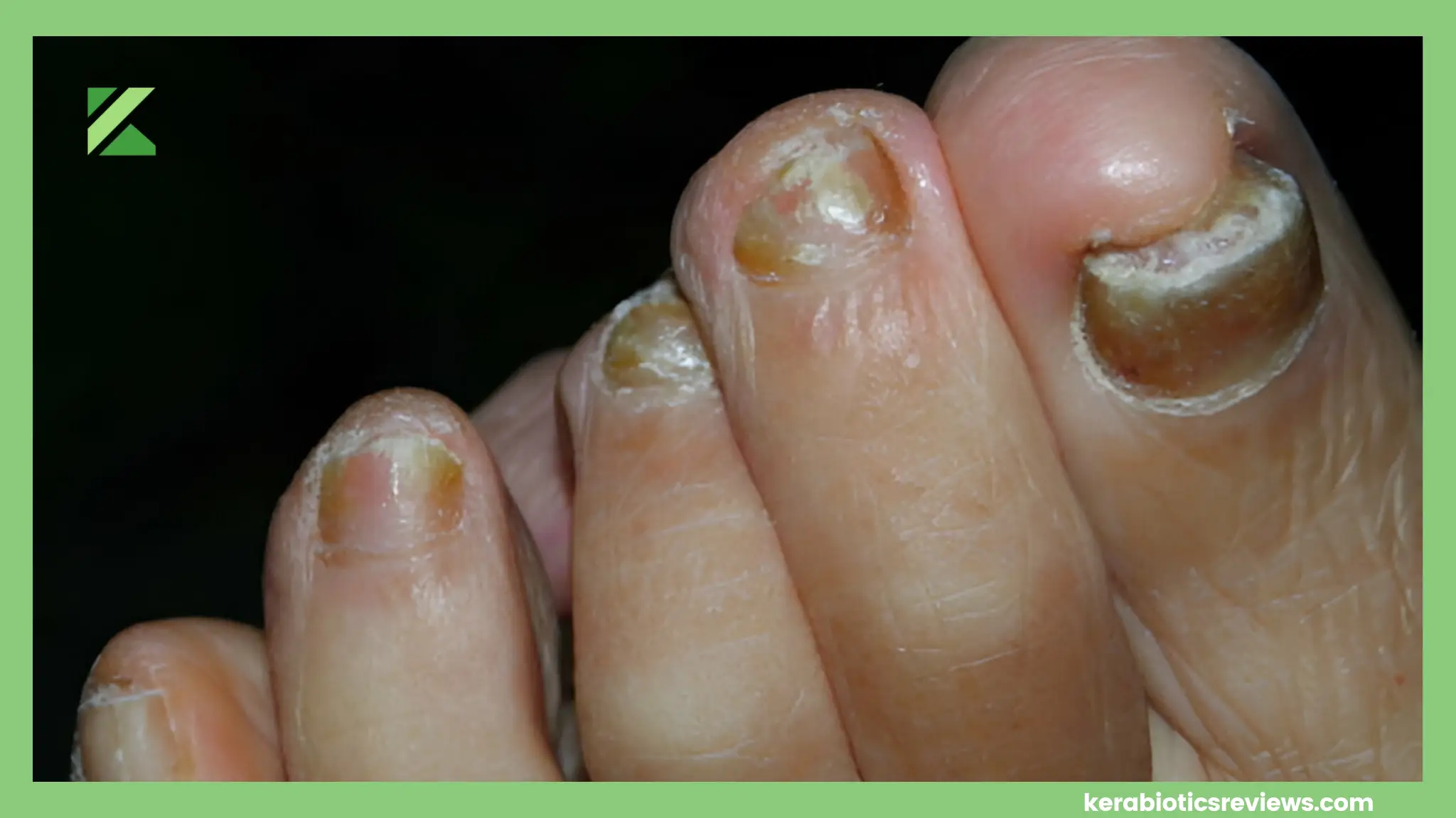 Signs Of Dying Toenail Fungus