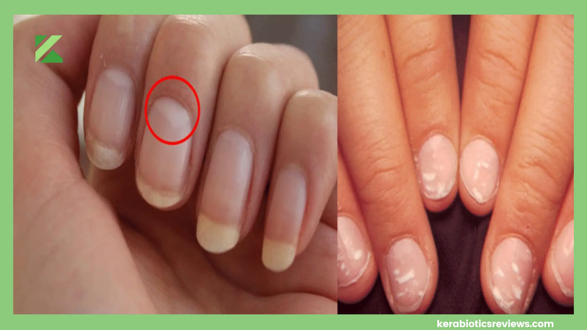 Signs Of Vitamin D Deficiency In Nails