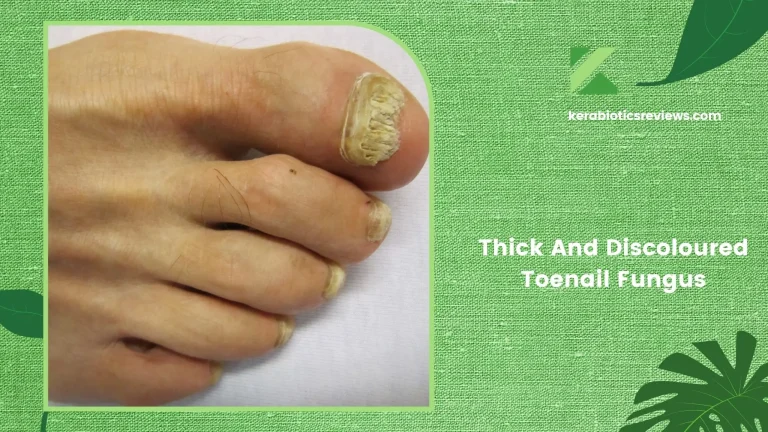 All You Need to Know About Thick And Discoloured Toenail Fungus