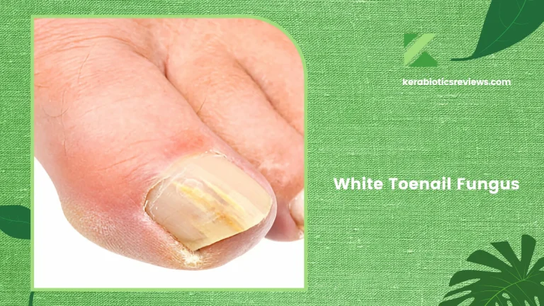 White Toenail Fungus: Causes, Signs, And Treatments!