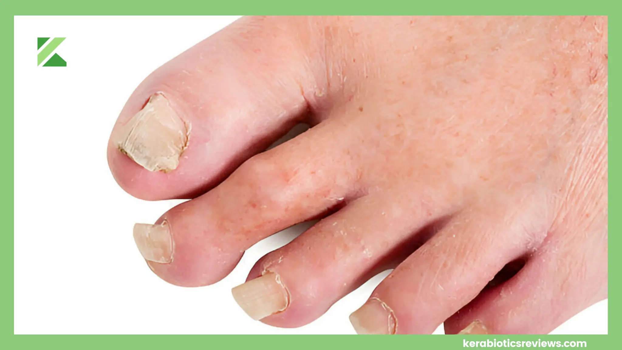 White Toenail Fungus Signs