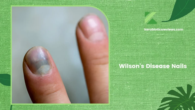 Wilson’s Disease Nails: When Blue Hues Signal A Rare Genetic Disorder?