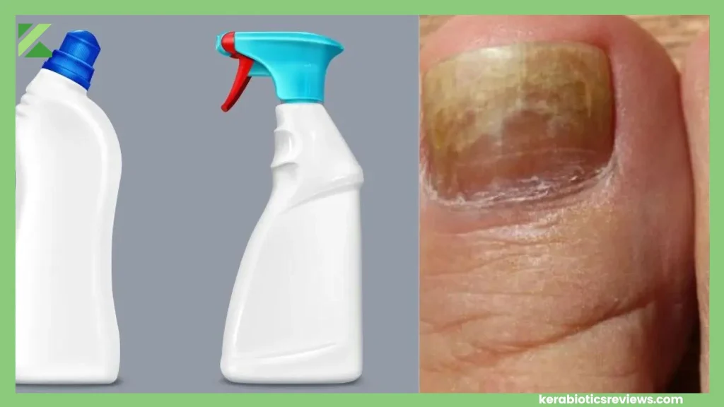 does bleach kill nail fungus